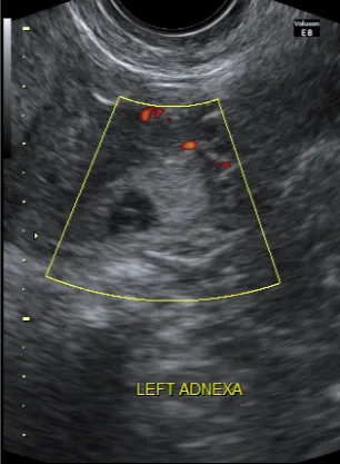 Live ectopic