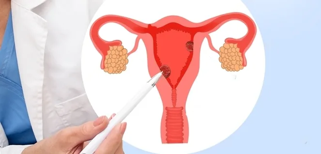 Dr Indira Ganeshan Endometrial polyps