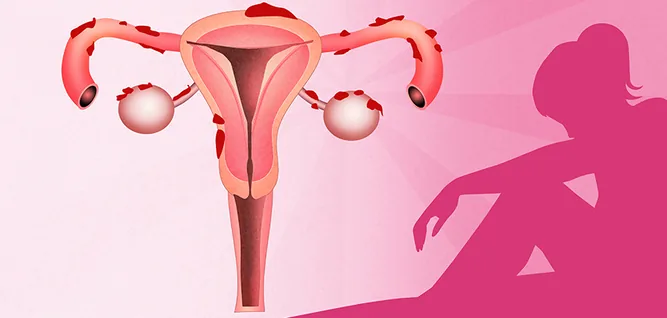 endometriosis