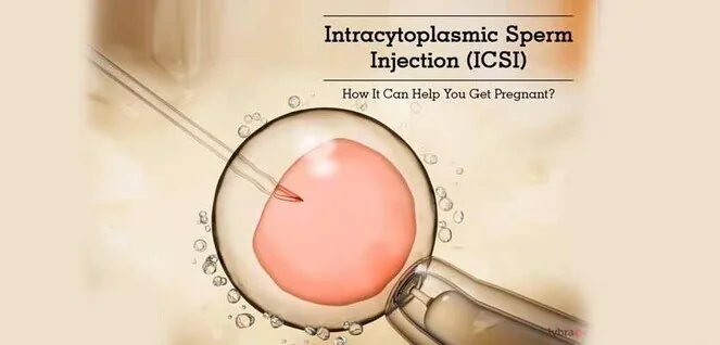 Irene IVF Clinic ICSI Treatment